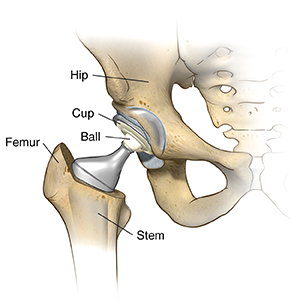 Front view of hip joint with hip replacement in place.
