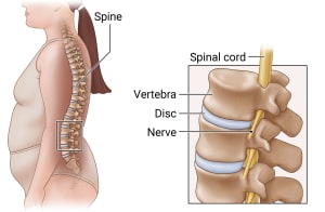 Side view of a person showing the spine. An inset shows a close up of the parts of the spine.