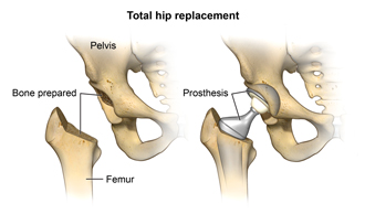 Total hip replacement showing the pelvis, bone prepared, femur and prosthesis