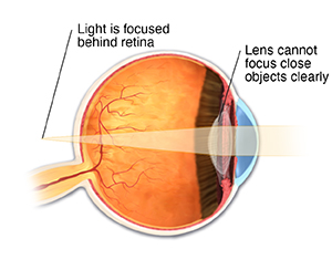 Cross section of eye showing presbyopia, with light focused behind retina.