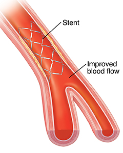 Cross section of artery showing blood flow through stent.