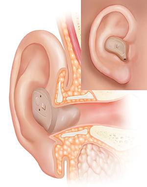 Cross section of ear showing hearing aid in place in ear canal with inset of external view.