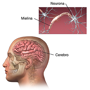 Vista lateral del cerebro en la cabeza de un hombre. En el recuadro, se muestran neuronas normales.