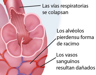 Recorte de las vías respiratorias colapsadas. Los sacos de aire han perdido de forma agrupada y los vasos sanguíneos están dañados.