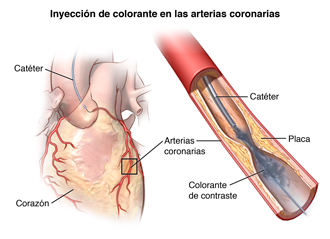 El corazón y una arteria obstruida que muestra un catéter en la arteria y la inyección de colorante.