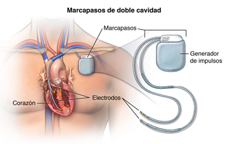 El marcapasos de doble cámara